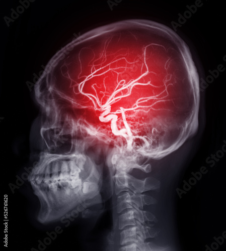 фотографія Skull image fusion with MRI MRA Brain  for evaluate them  stenosis  and stroke disease