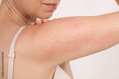 Skin redness and itching concept. Sensitive Skin, Food allergy symptoms, Irritation