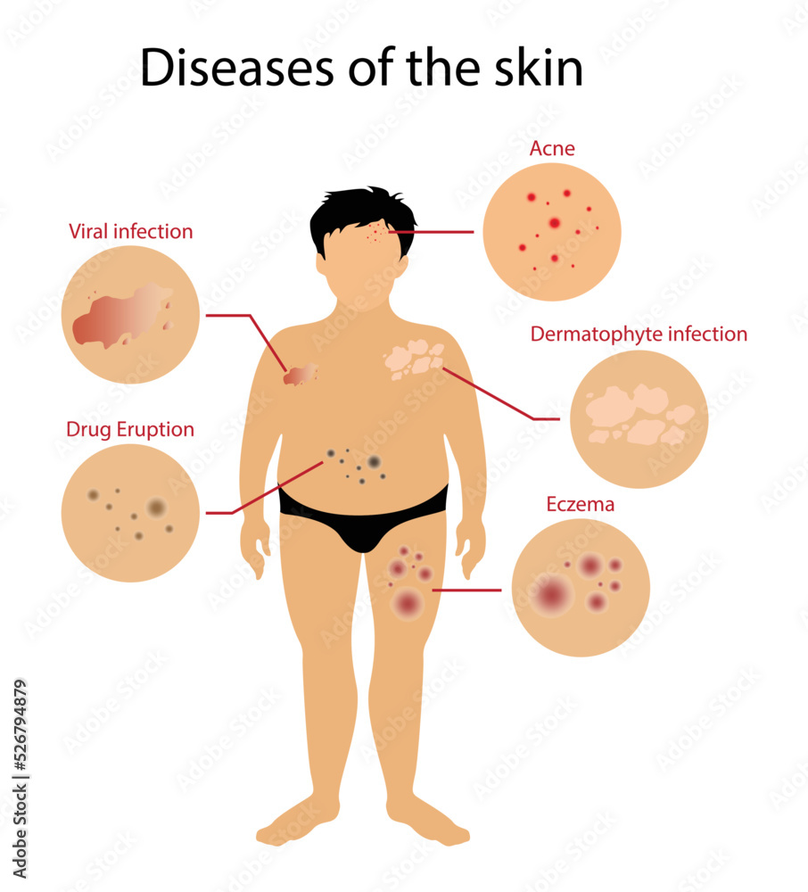 illustration of biology and medical, Diseases of the skin, Skin ...
