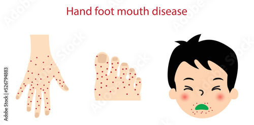 illustration of biology and medical, Hand foot mouth disease, contagious viral infection common in young children, Pictures of hand, foot, and mouth disease symptoms photo