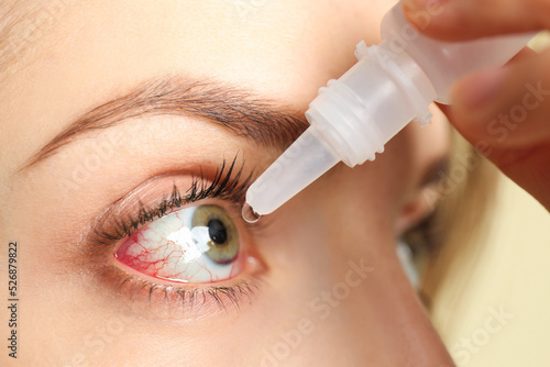Woman using eye drops on light background, closeup