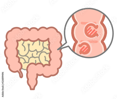 大腸ポリープの説明イラスト photo