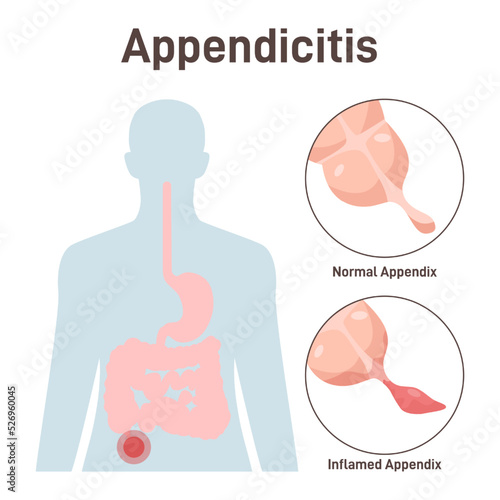 Appendicitis. Appendix inflammation disease. Anatomical diagram with large