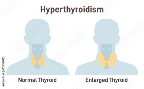 Hyperthyroidism. Thyroid gland produces too much of the hormone