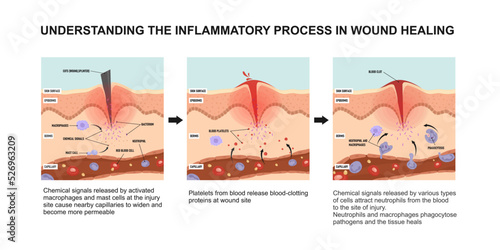 Understanding the inflammatory process in wound healing