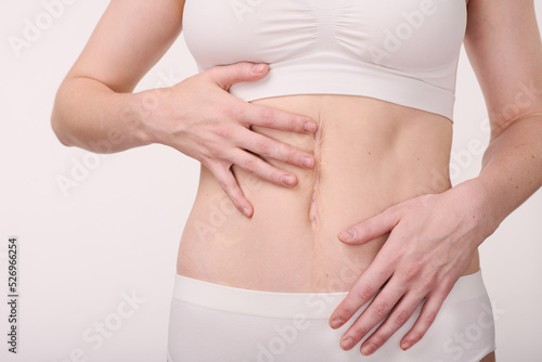 Close-up of young woman in underwear showing her scar on belly isolated on white background