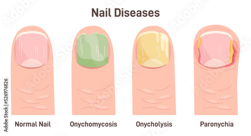 Onychomycosis, onycholysis, paronychia. Nail diseases, nail fungal