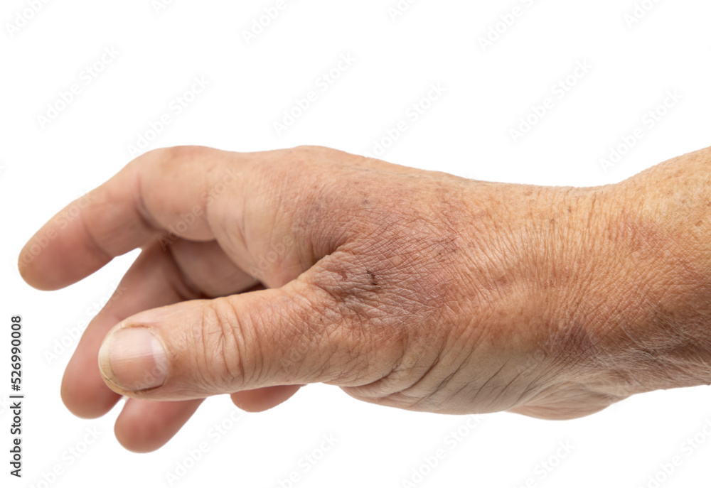 hot water burn on the skin of the hand hot water burn on the skin of the hand