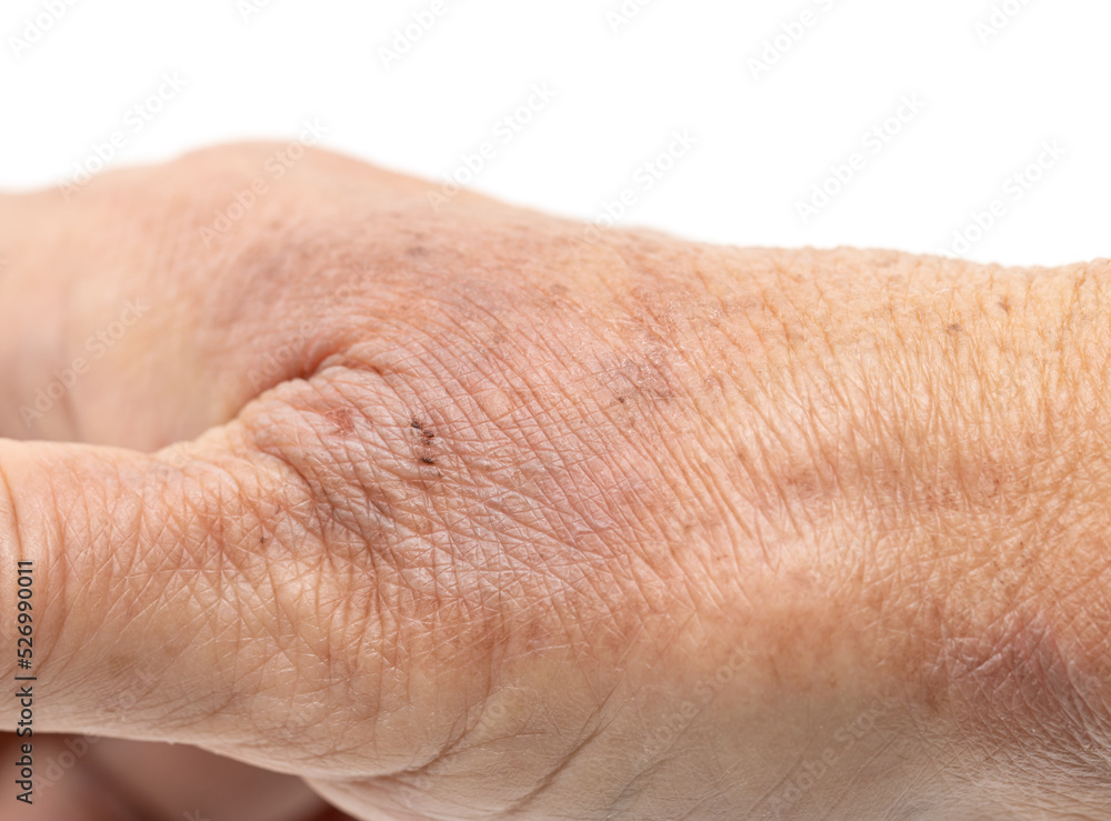 hot water burn on the skin of the hand