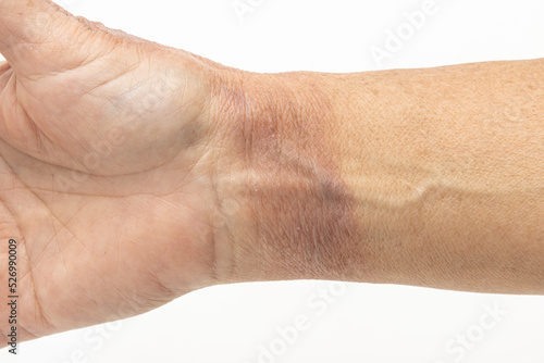 hot water burn on the skin of the hand