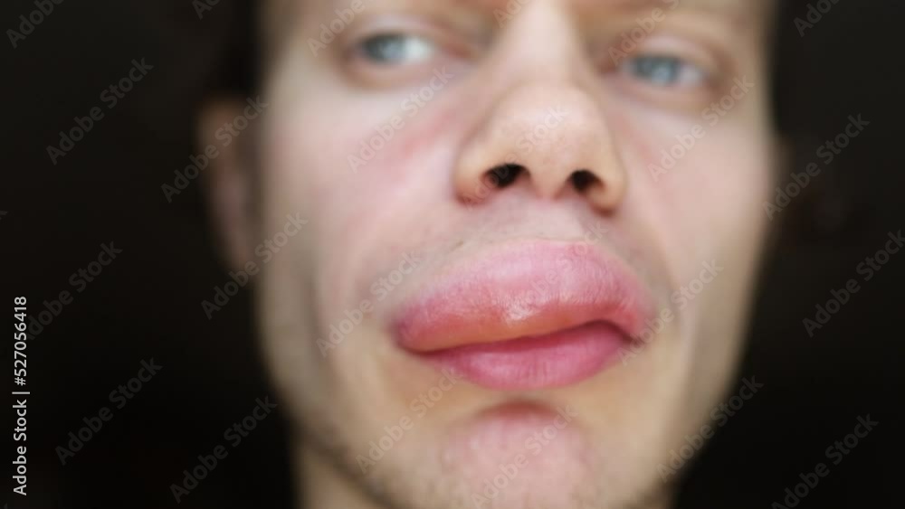 plump lips, allergic reaction of angioedema in a man on the lip. The concept of lip augmentation, cheiloplasty - lipofilling and botox injections plump lips, allergic reaction of angioedema in a man on the lip. The concept of lip augmentation, cheiloplasty - lipofilling and botox injections