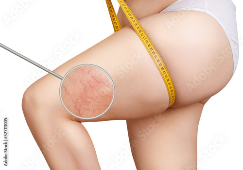 Legs of fat woman with varicose veins in the magnifying glass. photo