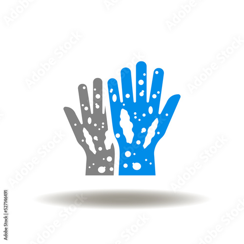 Vector illustration of hands with eczema skin. Icon of atopic dermatitis. Symbol of dermatological, allergic skin disease. Sign of psoriasis.