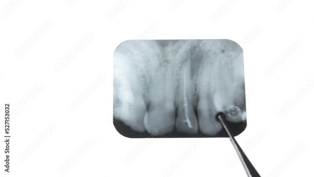 Cyst Xray of the tooth. Radicular cyst of the upper jaw. Pathological formation, a tumor in the
