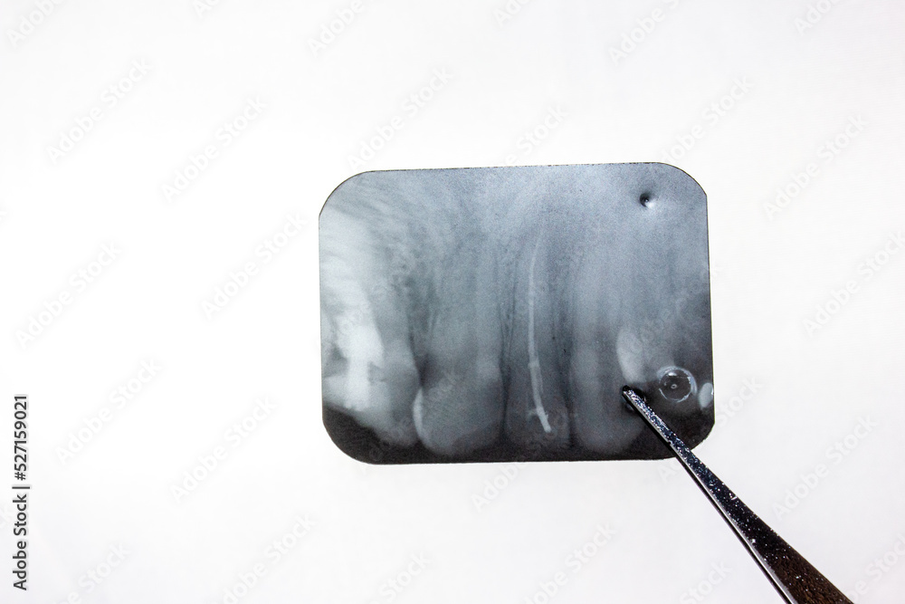 Cyst Xray of the tooth. Radicular cyst of the upper jaw. Pathological formation, a tumor in the
