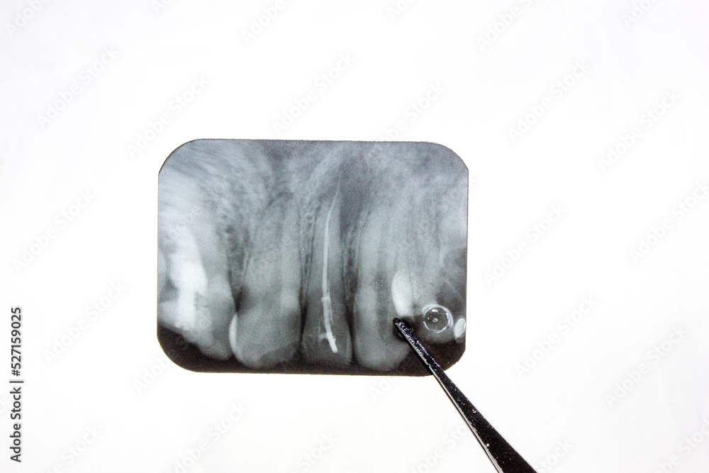 Cyst Xray of the tooth. Radicular cyst of the upper jaw. Pathological