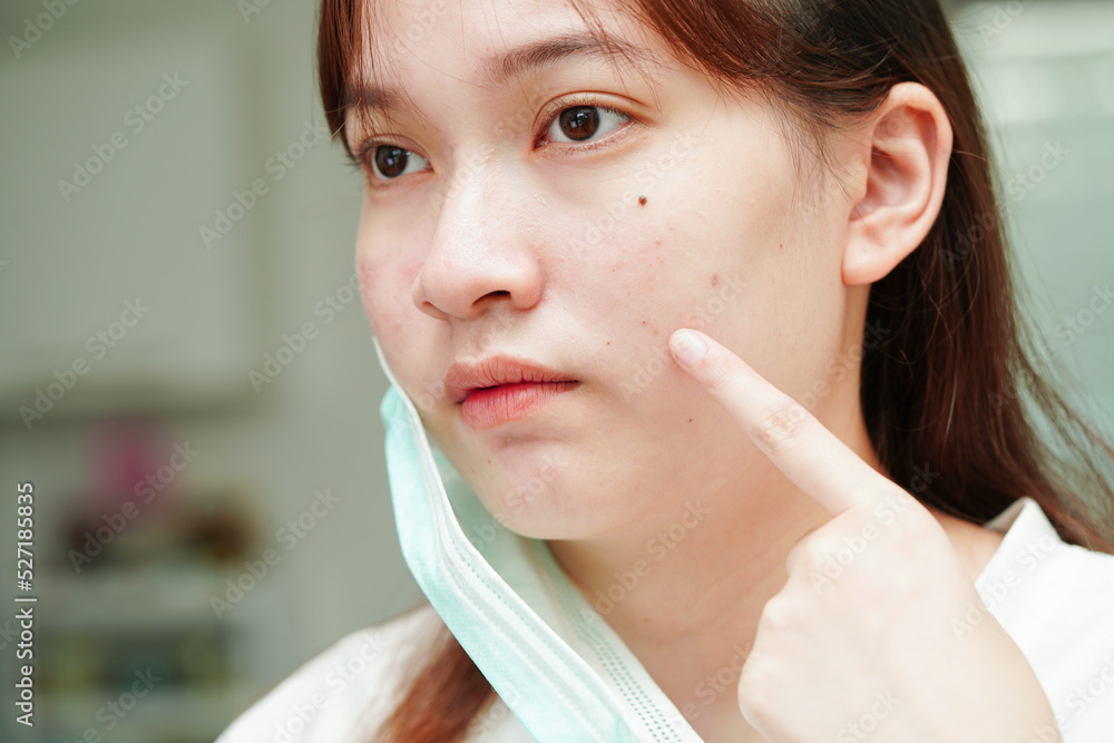 Acne pimple and scar on skin face, disorders of sebaceous glands, teenage girl skincare beauty problem. Acne pimple and scar on skin face, disorders of sebaceous glands, teenage girl skincare beauty problem.