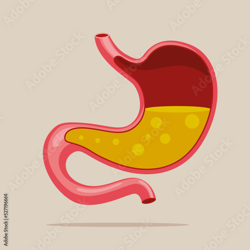Human stomach full of gastric acid, cut view. Gastroesophageal reflux disease. Vector illustration. 