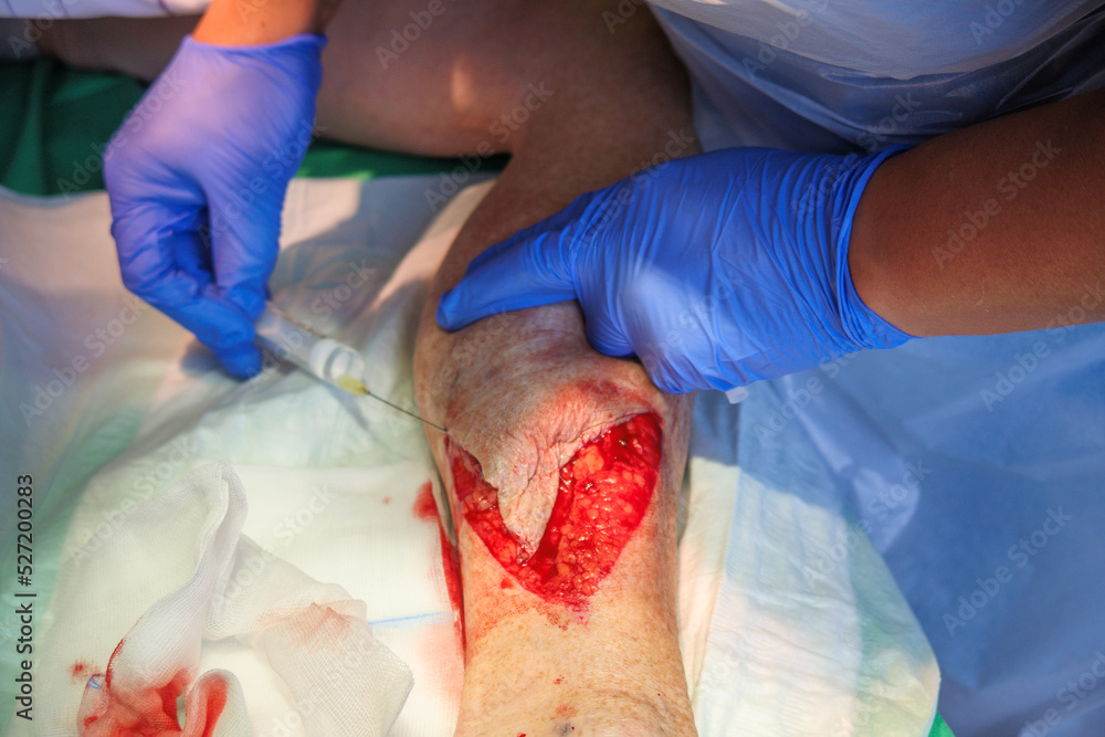 a laceration on the lower leg is locally anesthetized