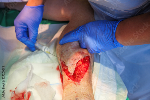 a laceration on the lower leg is locally anesthetized photo