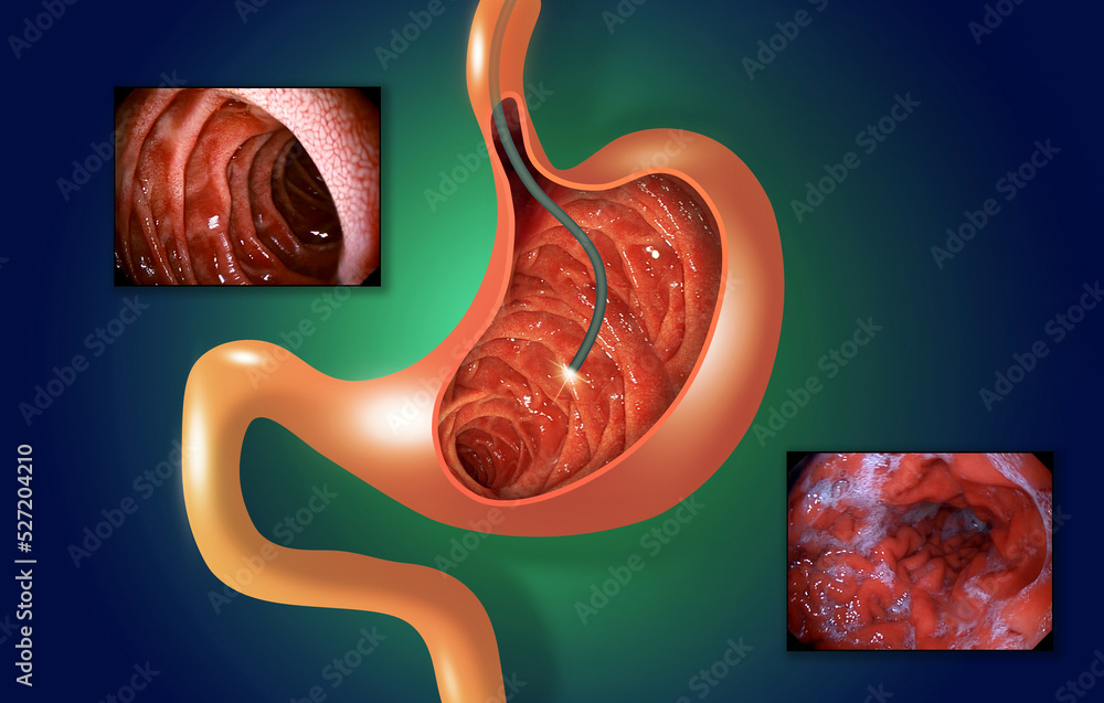 Ilustração do Stock Digestive endoscopy or gastroscopy. Performing a