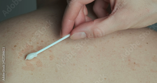 Doctor lubricates the red spots on the back of the patient with an ointment with a cotton swab. Treatment of skin disease, pityriasis versicolor, close-up.