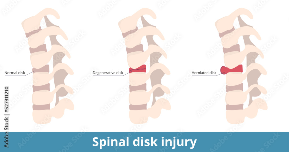 Spinal disk injury. The herniated disk causes pain, numbness, or weakness, and the degenerative disk results as dry out or cracking.  Causes of spinal pain and damage. - obrazy, fototapety, plakaty 