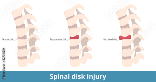 Spinal disk injury. The herniated disk causes pain, numbness, or weakness, and the degenerative disk results as dry out or cracking.  Causes of spinal pain and damage. photo