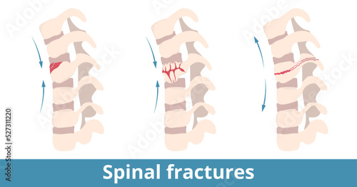 Spinal fractures. Types of spinal fractures depend on damage direction. Fracture of the vertebrae (backbone) caused from injury, trauma, fall, sports or some sort of high velocity impact.