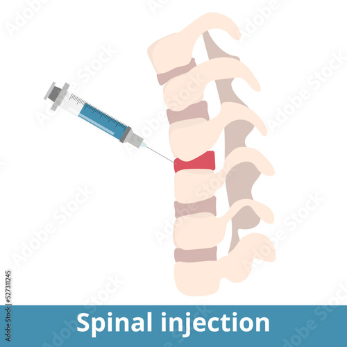 Spinal injection. Spinal Injections can be performed to diagnose the source of pain or as a treatment to relieve pain. Syringe injection into spinal disk.