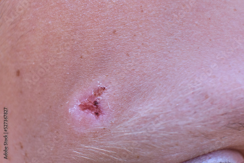 A wound on a child's head