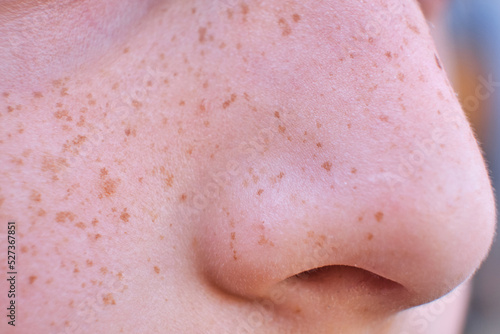 Freckles on a child's face. Close-up of skin spots