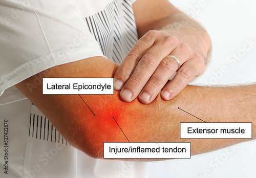 Canvas Print Chart explanation of lateral Epicondylitis or tennis elbow problem in man over use arm causes  muscle strain injure or micro tearing of the tendons that join the forearm muscles on outside of elbow