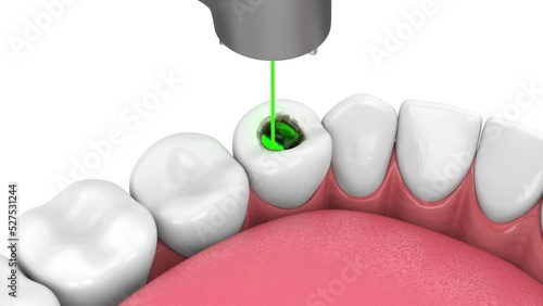 Removing tooth decay with dental laser without dental drill