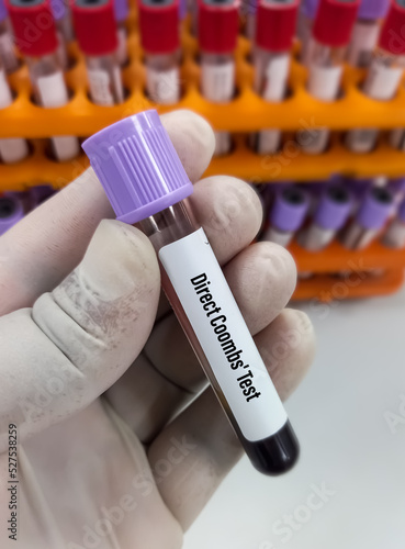 Blood sample for Direct Coombs Test, diagnosis of hemolytic anemia or hemolytic disease.