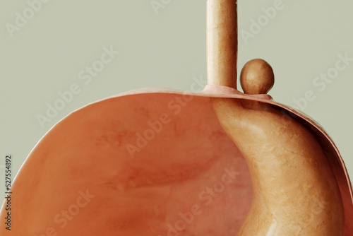 Paraesophageal Hiatus Hernia Type 2 - Stomach protrusion through diaphragm, gastric entrance in normal condition - 3D rendering photo