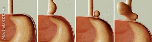 Photos Hiatus hernia - Healthy and 3 types of diaphragmatic hernia - 3D rendering