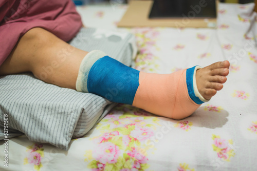Close-up Of A Women's Broken Leg . © bussapa