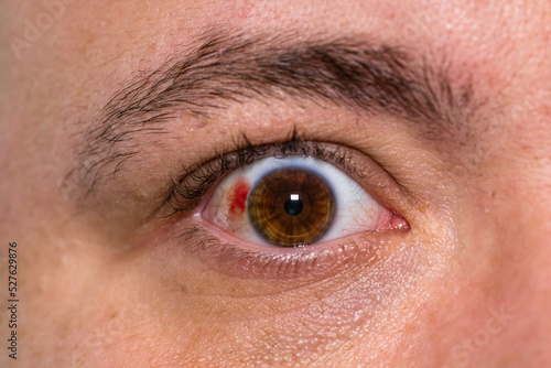 Foto Eye injury, young man with burst blood vessel in eye, fatigue, problems with blo