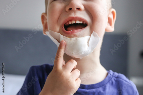 baby chin in bandage. Pain, injuries of children. Broken chin