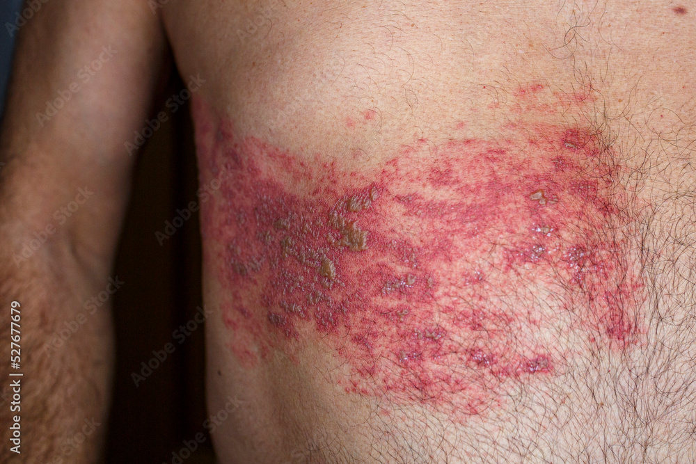 Foto Stock Skin lesion symptom in Shingles or Herpes zoster in human