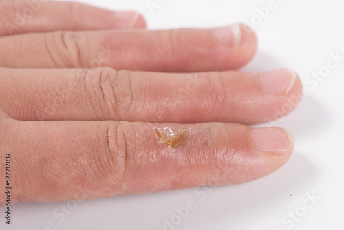 Wallpaper Mural Close up photo of painful thermal injury from hot water, scalds wound.  Torontodigital.ca