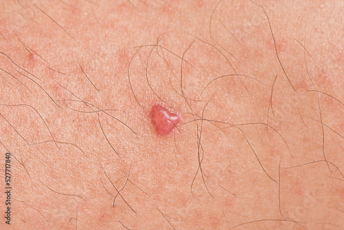 Red blister bleb on skin close up.