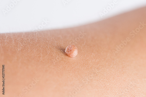 Skin tag or acrochordon or soft fibrom dermatology problem on skin concept.
