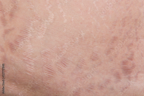 stretch marks and scars, striae gravidarum photo