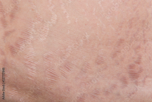 Fotografie stretch marks and scars, striae gravidarum