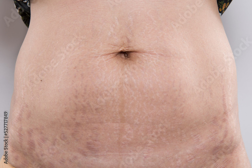 stretch marks and scars, striae gravidarum photo