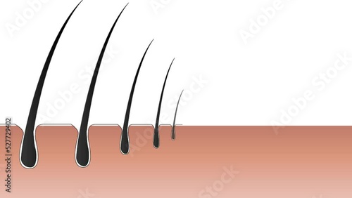 Stages of hair loss, fall:
With hair follicles getting smaller, the hair shaft starts getting thinner in every growth cycle, reducing them to soft and light hair and eventually complete disappearance.