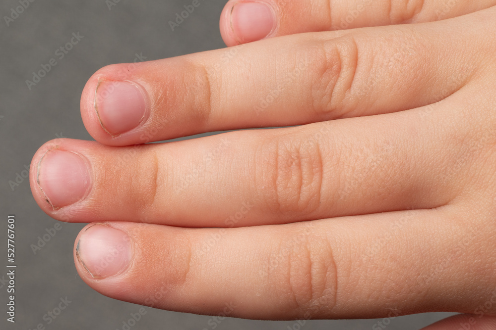 Child's dirty and sloppily cut nails, fingers and toenails close-up. Child's dirty and sloppily cut nails, fingers and toenails close-up.