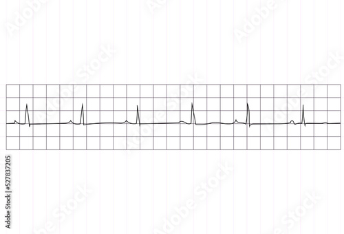 T wave represents the repolarization (or recovery) of the ventricles photo